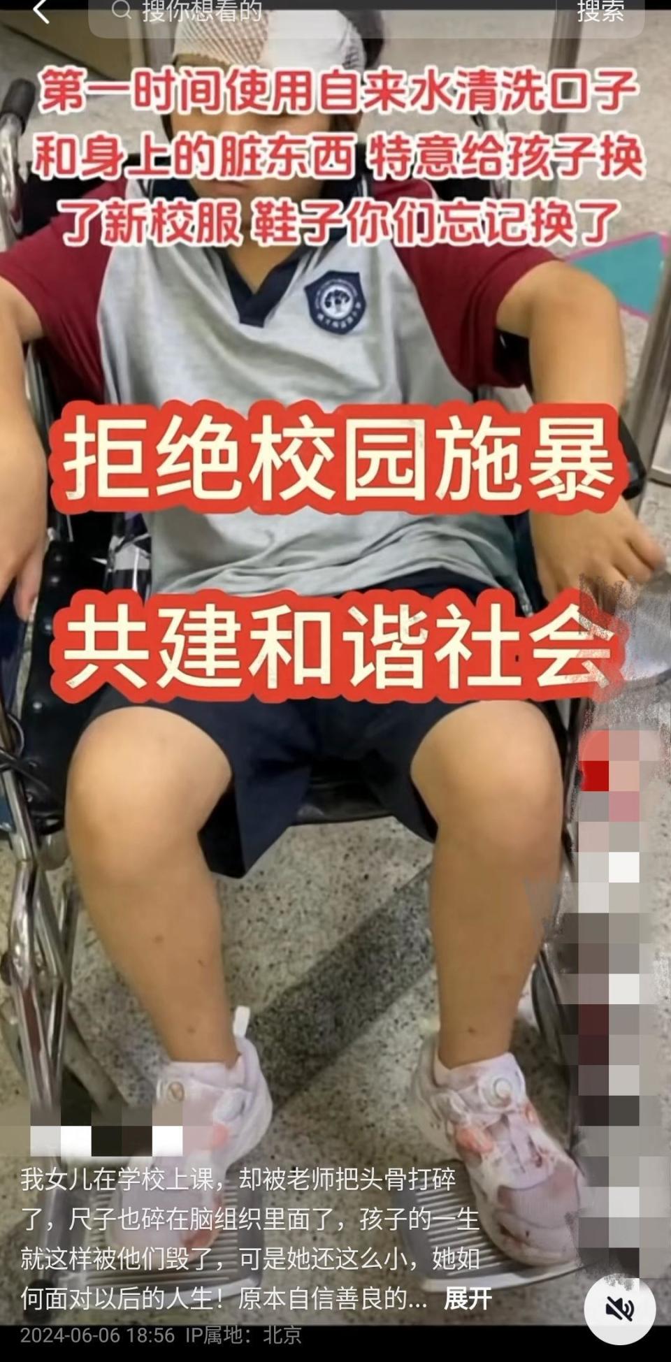 天顺平台注册：9岁女生被老师投掷三角尺嵌入头部，治疗一年后遗症严重，案件将开庭